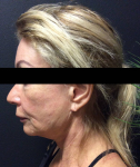 Ultherapy Case 2 Before